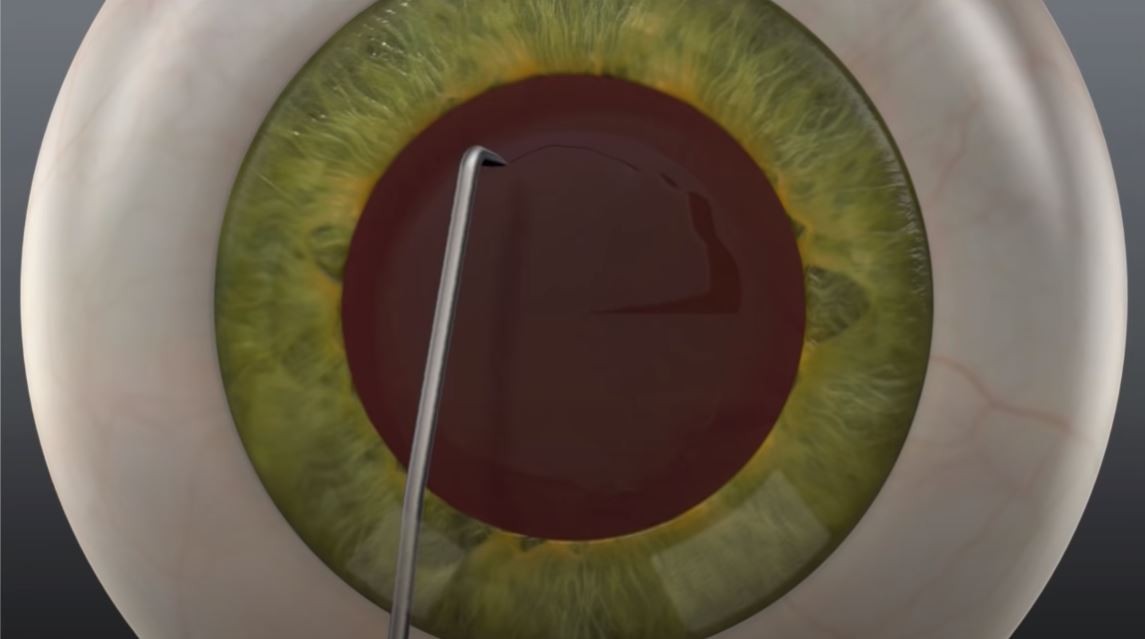 MANUAL CATARACT SURGERY VS LASER CATARACT SURGERY
